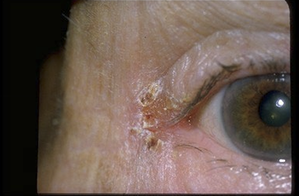 <p>An infection of the canthus by Staphylococcus aureus or Moraxella lacunata </p>