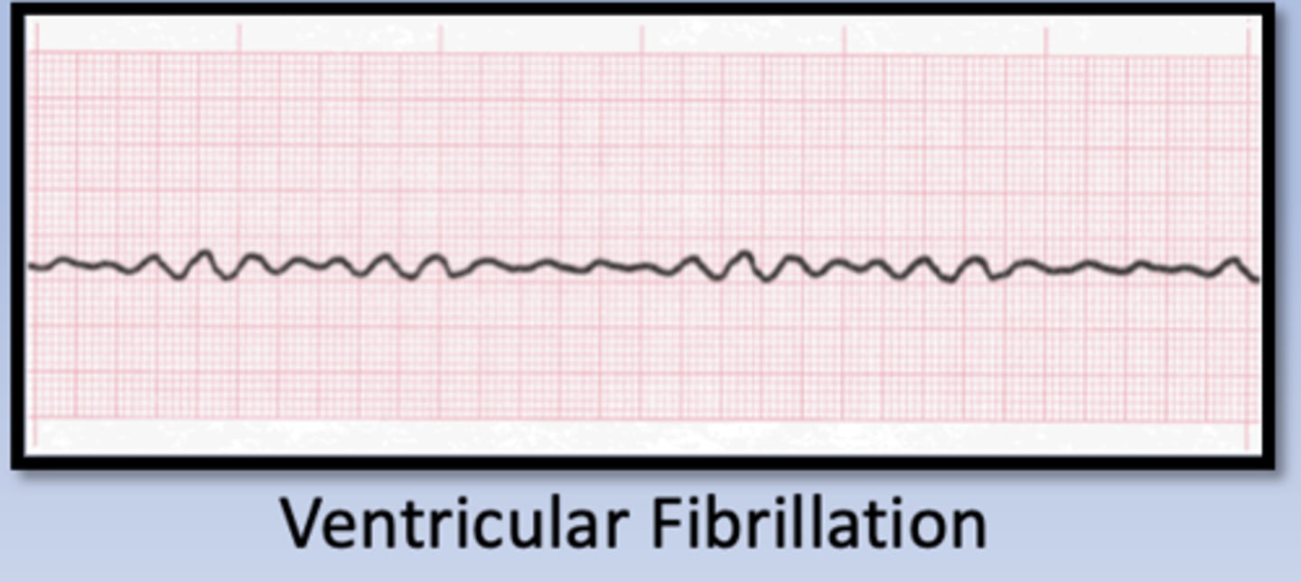 <p>______ Tachycardia</p><p>- ventricular fibrillation</p><p>- ventricular tachycardia</p>