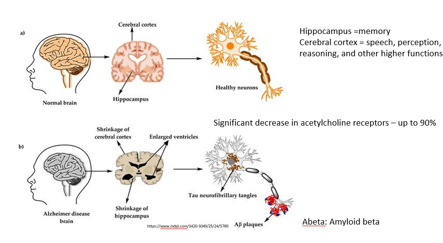 <p>Shrinkage of cerebral cortex and hippocampus (which are important for higher functions such as speech, perception, reasoning; and memory, respectively) <br>and<br>significant decrease in Ach receptors (up to 90%)<br>and<br>tau protein tangles and amyloid beta plaques on neurons (see image) </p>