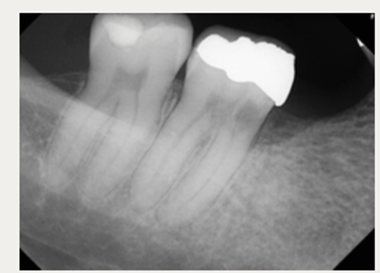 <p>These are a part of which treatment for External Cervical Resorption (ECR)? </p><p>- For symptomatic, untreatable lesions, or for</p><p>patients who wish to be proactive about treatment</p>