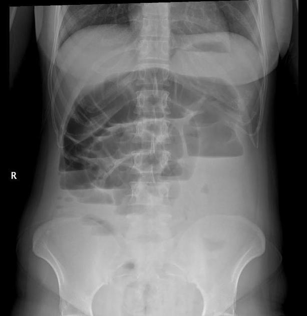 <p>Small or Large Bowel Obstruction?<br>(patient is erect)</p>