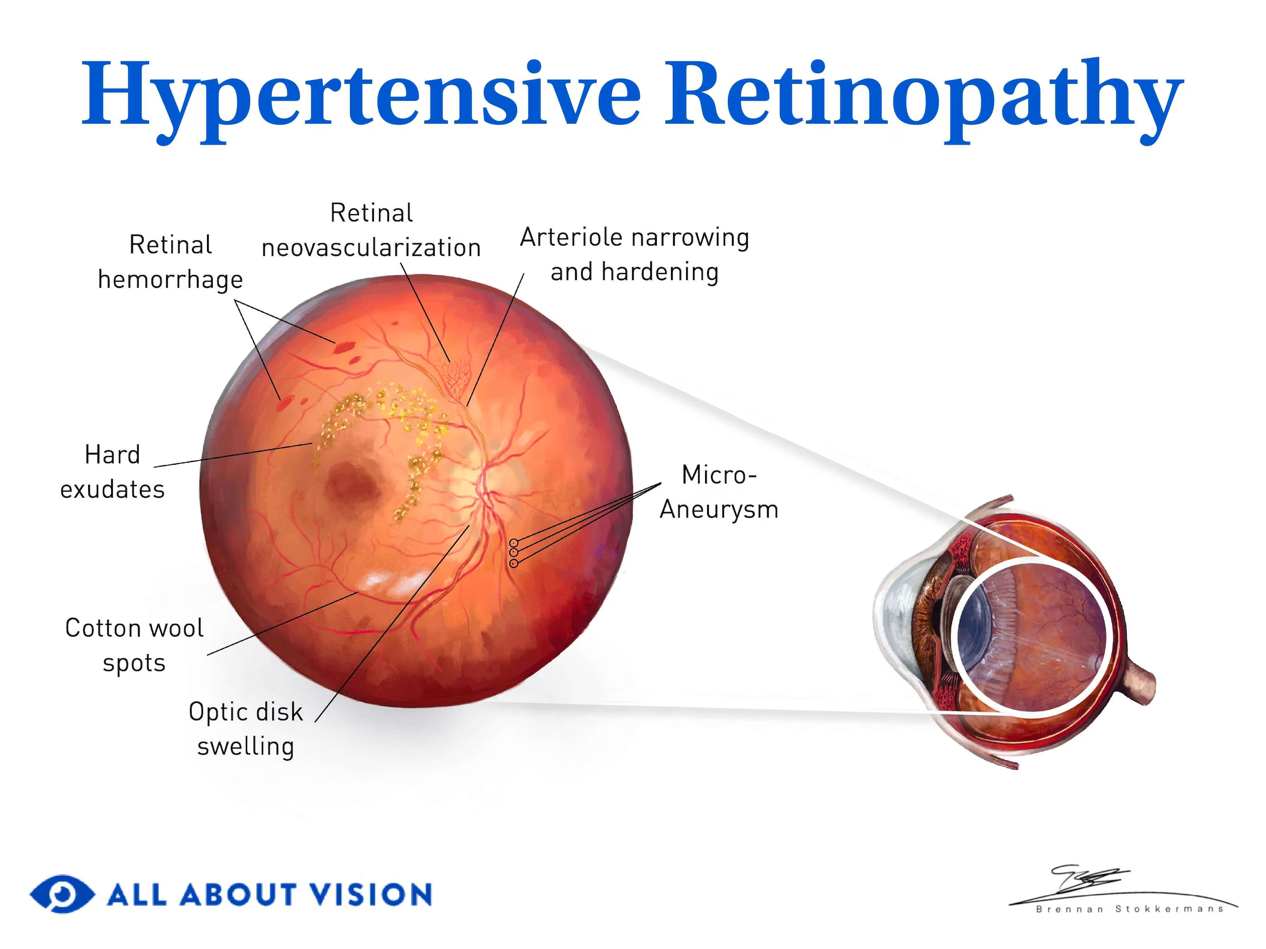 <p>PP: superficial hemorrhages<br>flame-shaped hemorrhages</p><p>E: macular star exudates<br>cotton wool spots</p><p>CM: AV nicking (abrupt end to vessels+no narrowing)<br>AV tapering (abrupt end to vessels+narrowing)<br>increased arteriolar light reflex→copper+silver wiring</p>