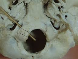 <p>Passageway for hypoglossal cranial nerve XII, begin at the lateral base of each occipital condyle OCCIPITAL</p>