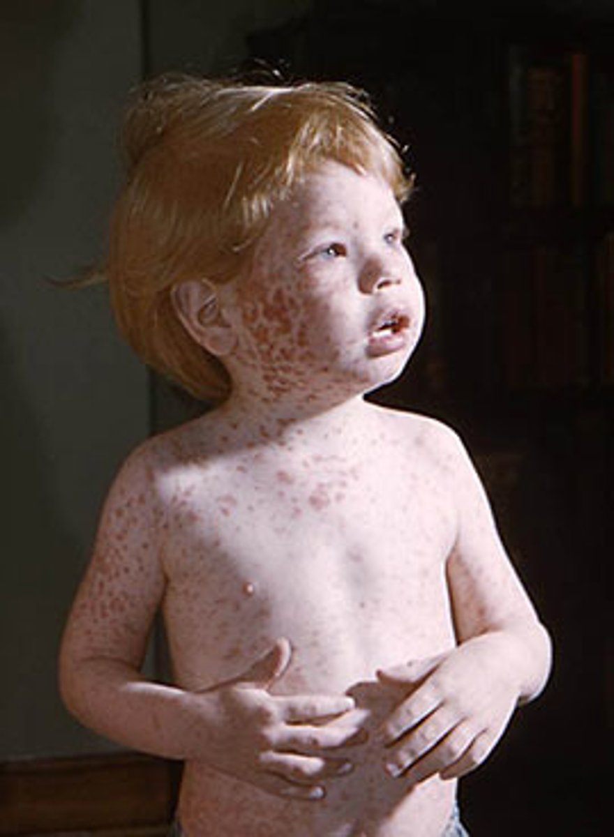 <p>Relatively minor rash disease with few complications</p><p>- tetrogenic, if acquired congenitally, can cause birth defects</p>