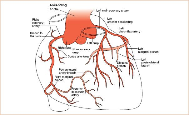 <p><strong>Lateral wall infarction,</strong> typically due to occlusion of the <strong>proximal left circumflex artery.</strong></p>