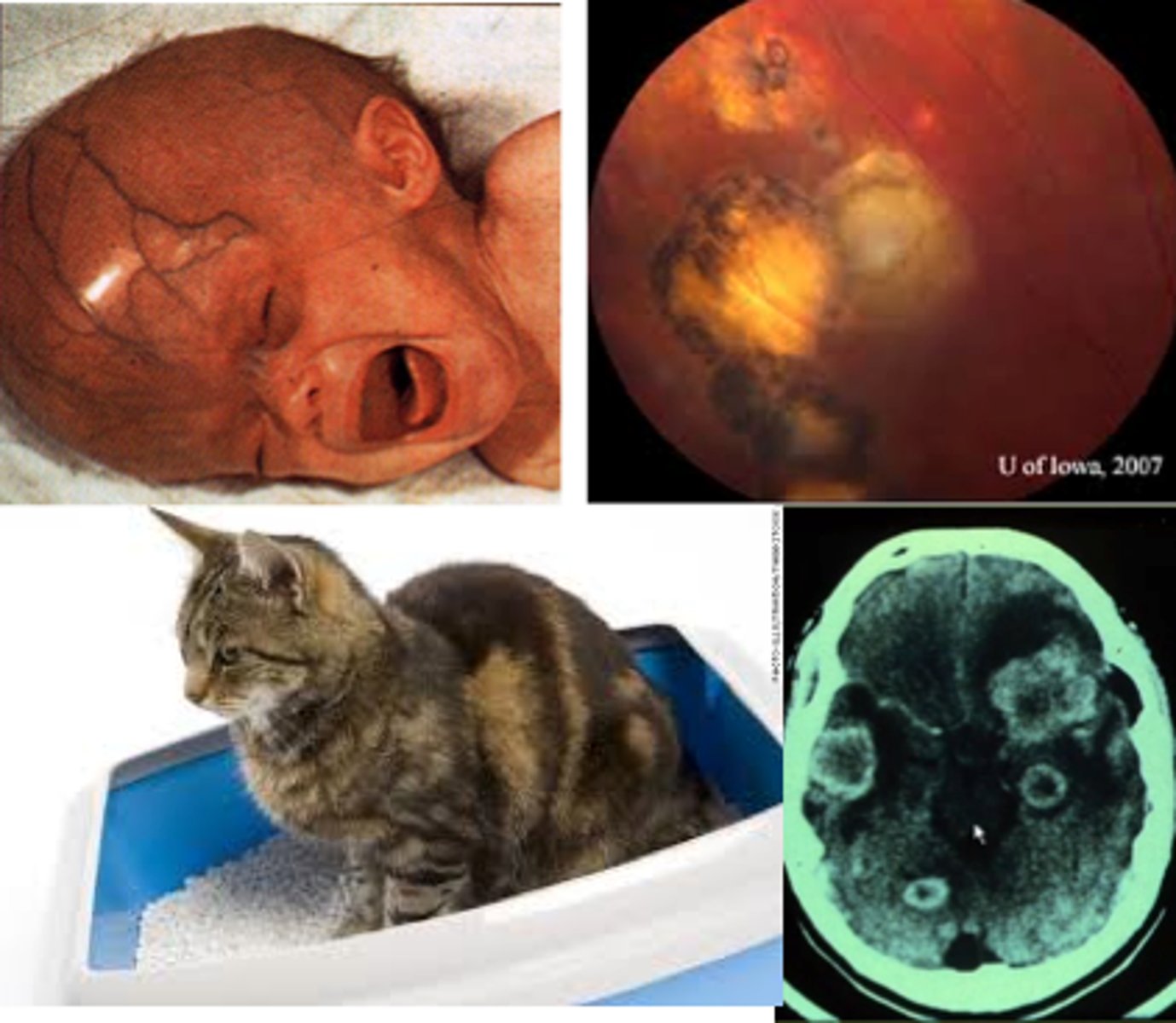 <p>Congenital Toxoplasmosis</p>