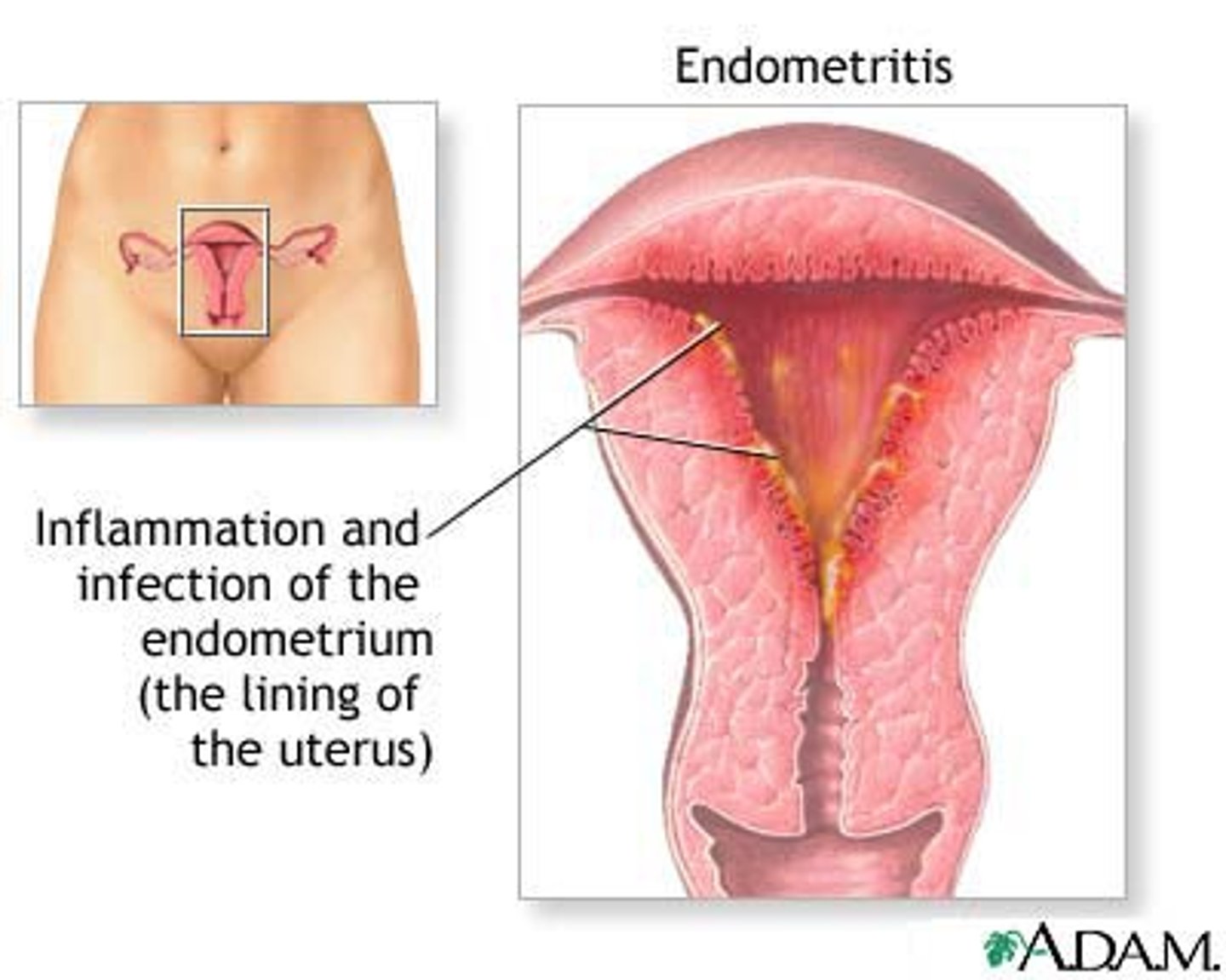 <p>inflammation of the inner lining of the uterus</p>