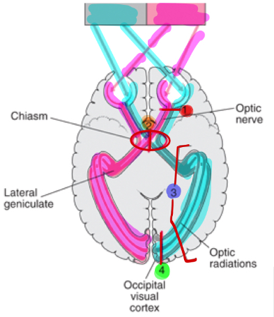 <p>What parts visual field defects correspond to a lesion at position 1 </p>