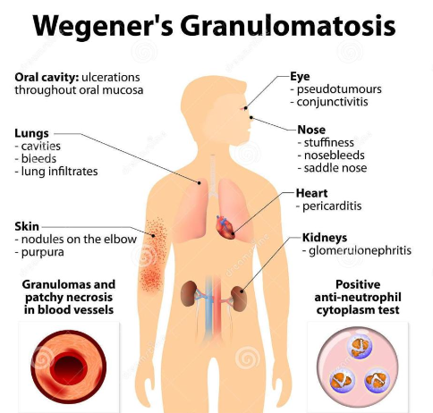 <p>Wegener Granulomatosis</p>