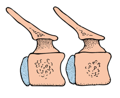Center of vertebrae that consists of an intercentrum and a pleurocentrum