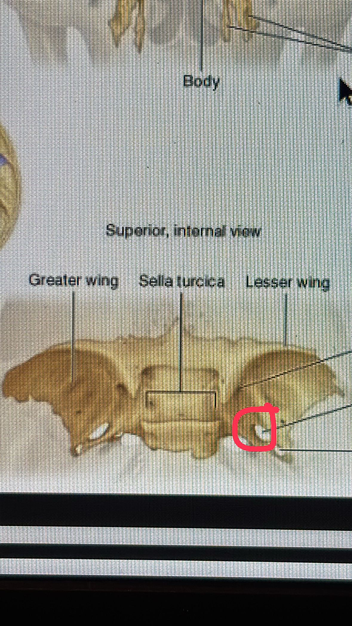 <p>bigger whole on the eye bat towards the back of the head</p>