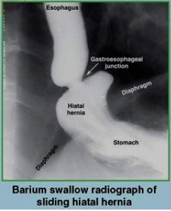 hernia of cardia of stomach into thorax; can damage vagal trunks, causing hyposecretion of gastric juice