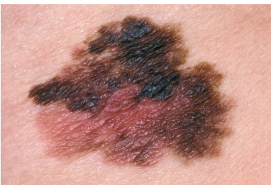 <p>What is a malignant melanoma?</p>