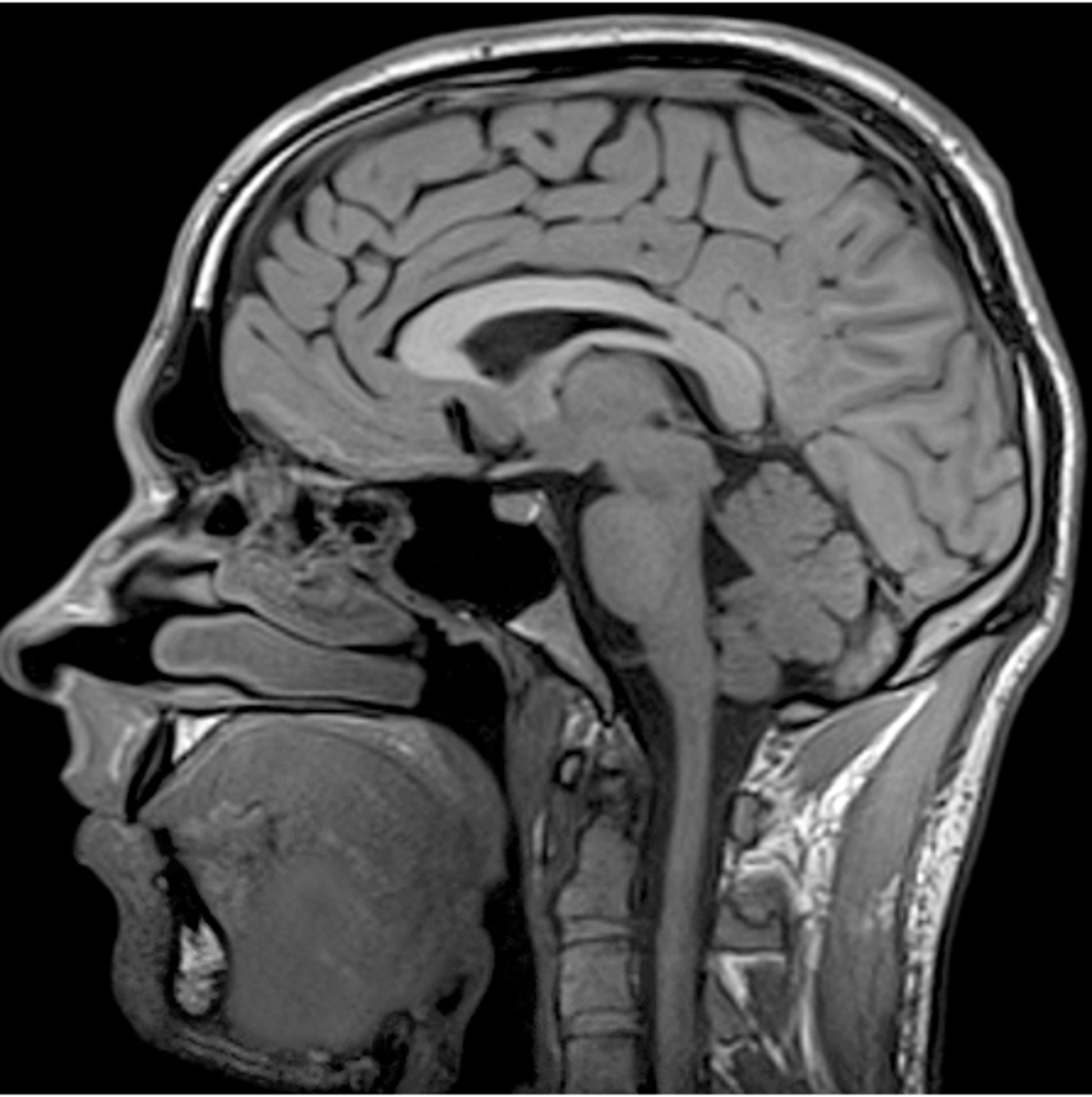 <p>soft tissue disturbances (tumors, brain infections, dementia, inflammation)</p>