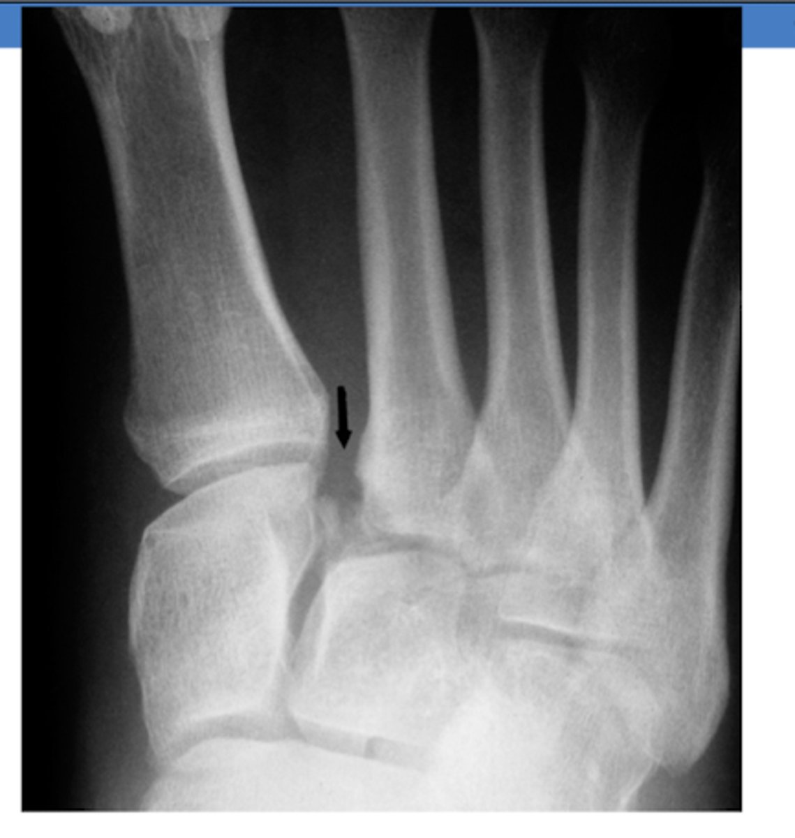 <p>casting for 6 weeks</p><p>- cannot bear weight</p>