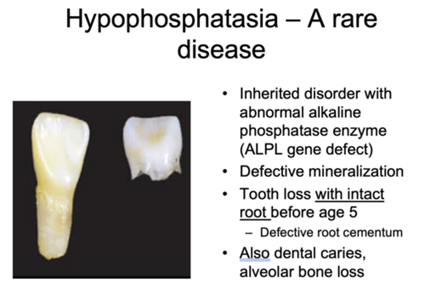 <p>Hypophosphatasia</p>