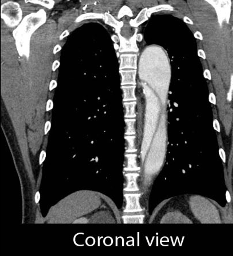 <p>What does this coronal CT view refer to </p>