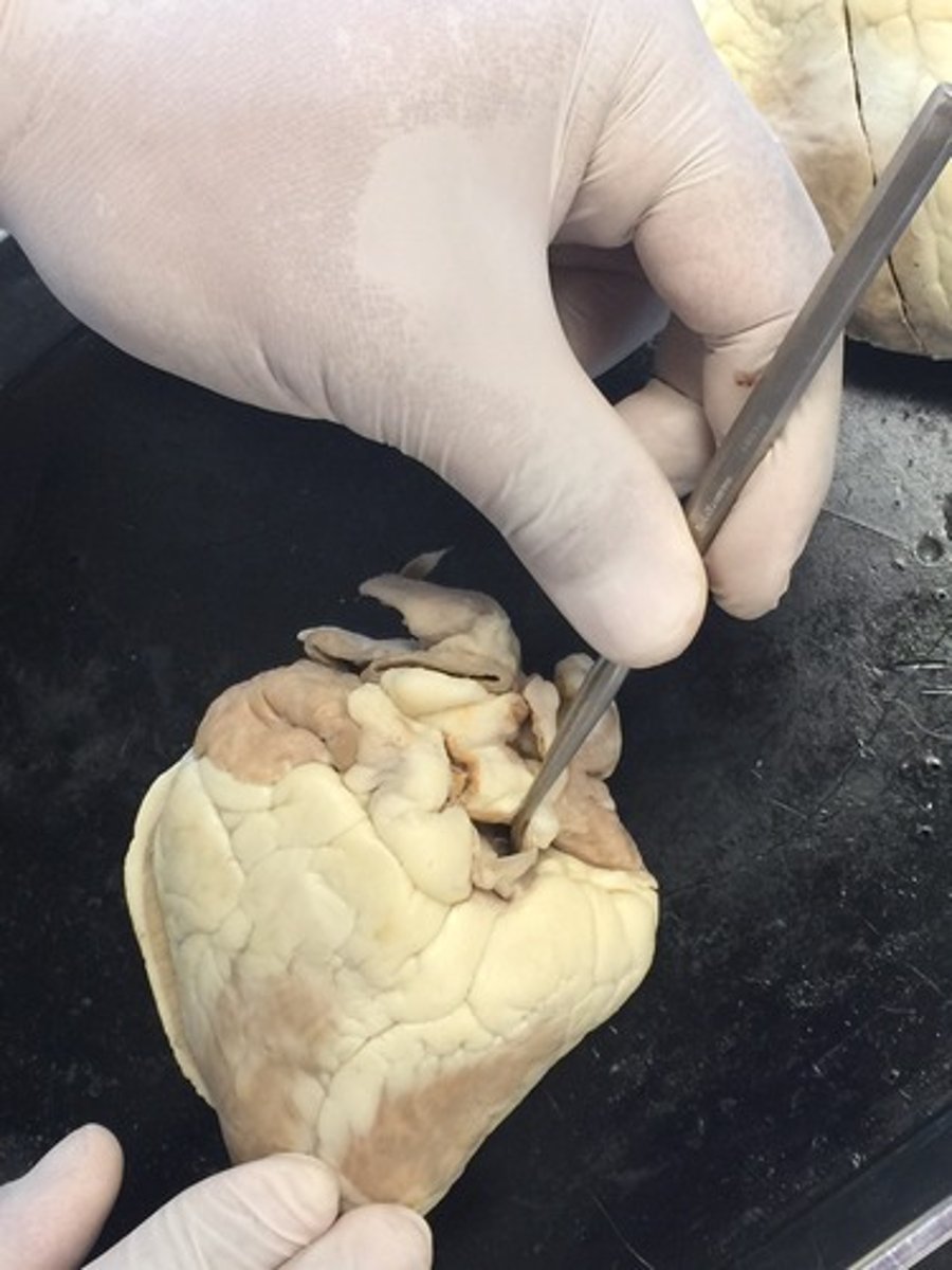 <p>posterior interventricular sulcus always leads to..</p>