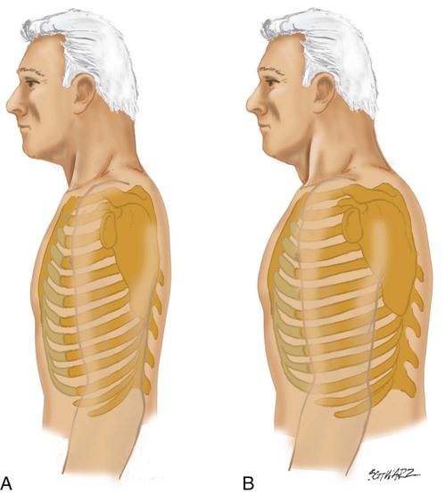 <ol><li><p>increased anteroposterior (AP) diameter (wider upper chest) and kyphosis (outward curve of the thoracic spine)</p></li><li><p>chest expansion may be somewhat decreased but remains symmetric</p></li><li><p>tend to tire easily during auscultation requiring deep mouth breathing</p></li><li><p>decreasing lung capacity </p></li><li><p>decreased gas exchange</p></li><li><p>chest wall stiffen</p></li><li><p>increased risk for respiratory infections</p></li></ol><p></p>