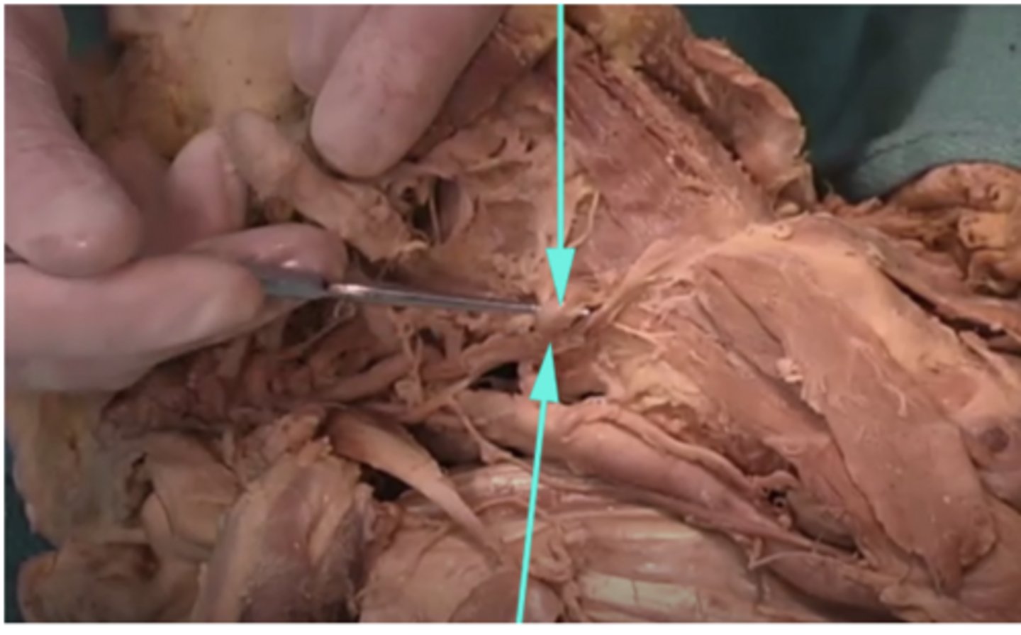 <p>What is this region being shown by the arrows?</p><p>-Brachial plexus</p><p>-Lingual artery</p><p>-Dorsum of the tongue</p><p>-Lingual nerve</p>
