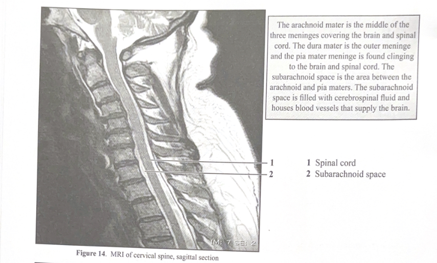 <ol><li><p>Spinal cord </p></li><li><p>Subarachnoid space </p></li></ol><p></p>
