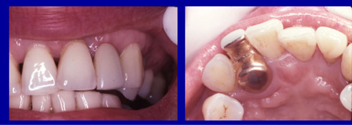 <p>• Open margins</p><p>• Overhanging margins</p><p>• Open contacts/food Impaction</p><p>• Over contoured restorations</p>