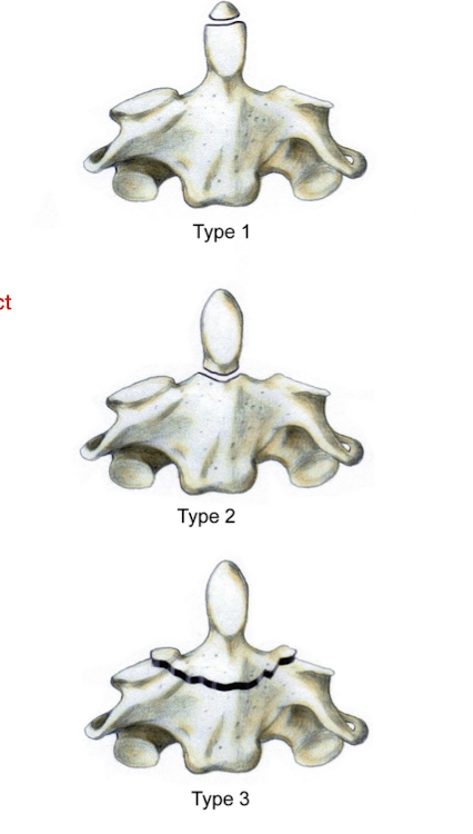 <ul><li><p>Type 2</p><ul><li><p>Intact transverse and alar lig w poor bony contact</p></li></ul></li></ul><p></p><p></p>