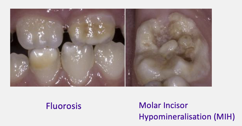 <ul><li><p>fluorosis</p></li><li><p>molar incisor hypomineralisation (limited to first permanent molar teeth and incisors)</p></li></ul><p></p>