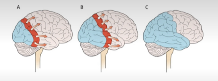<p>Migraine is preceded by cortical spreading depression. Wave of electrical activity; followed by neuronal inhibition. This triggers changes in NT and inflammatory substances. This wave activates trigeminal nerve system (leading to headache) and sometimes aura.</p><p>It happens due to predispoision to neuronal hyperacitity, possibly due to mutations in Ca channels, Na/K ATPase, VG-Na channels, glutamate related proteins, etc.</p>