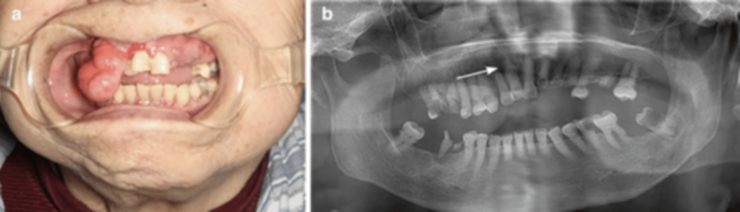 <p>odontogenic epithelium embedded in fibrous storm</p><p>-> slow growing + painless</p><p>xray- radiolucent lesion -> unilocular or multilocular</p><p>causes cortical expansion/ tooth displacement</p>