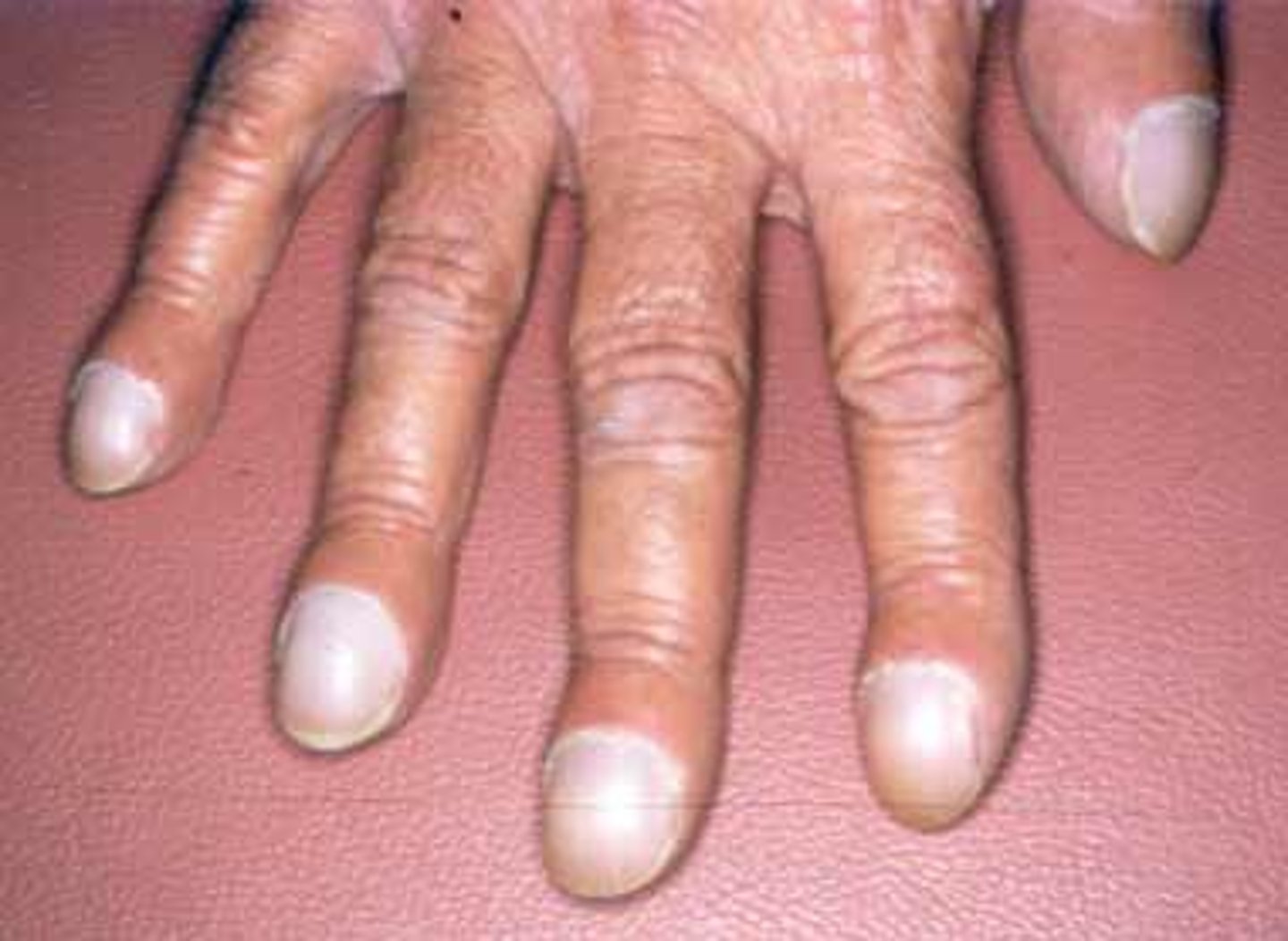 <p>• Altered thought processes</p><p>• Headaches</p><p>• Chest pain</p><p>• Enlarged heart</p><p>• Clubbing of fingers/toes</p><p>• Anorexia = cachexia</p><p>• Constipation</p><p>• Decreased urinary output</p><p>• Weakness of extremity muscles</p><p>• Muscle pain</p>