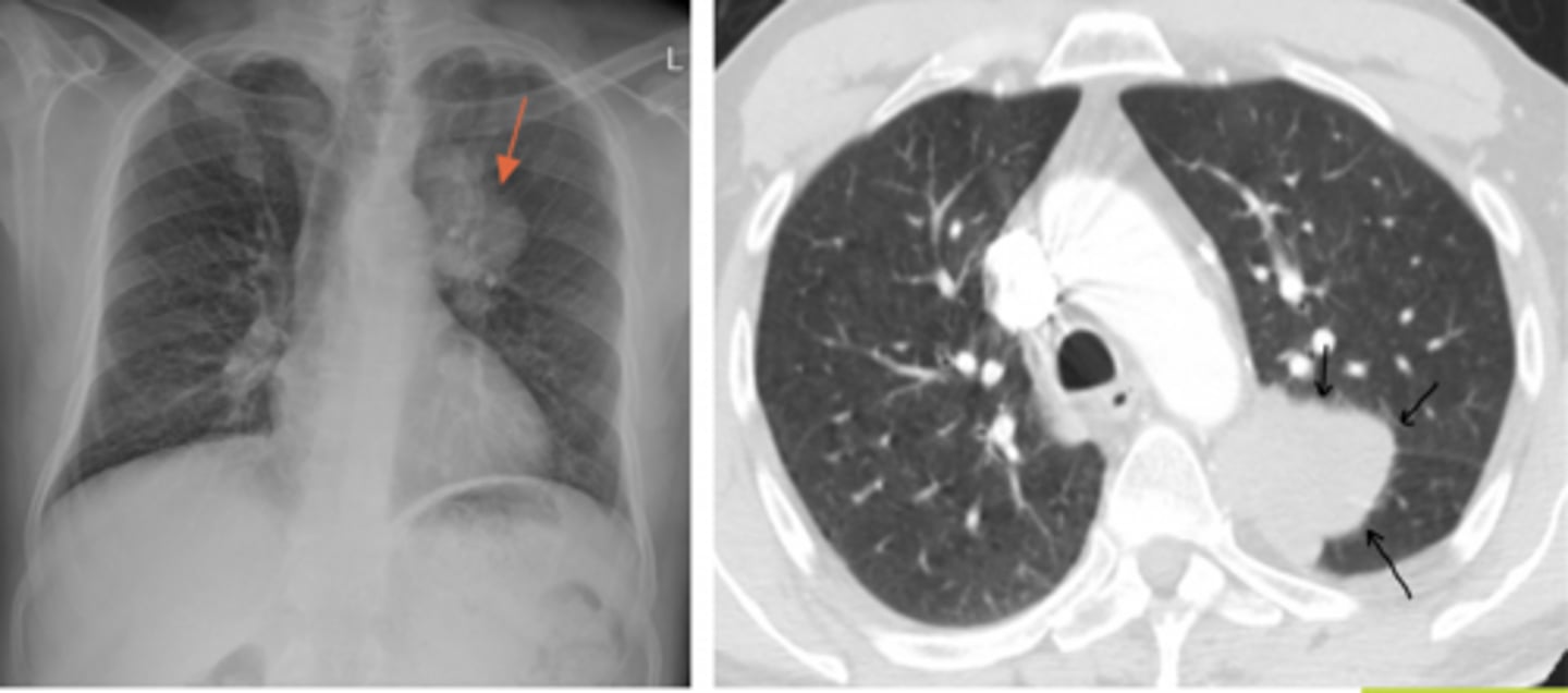 <p>A 67-year-old man presents with a 4-month history of persistent cough and increasing fatigue. He reports coughing up small amounts of blood on several occasions over the past month. He has also noticed an unintentional 15-pound weight loss and decreased appetite. He smoked 1.5 packs of cigarettes daily for 45 years.</p>