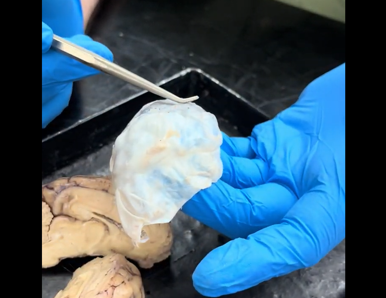 <p>What is this white structure that coats the outside of the brain called?</p>