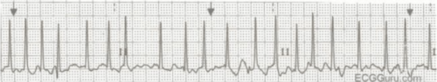 <p><br>D. Atrial fibrillation</p>