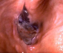 <p>What is Melanoma?</p>