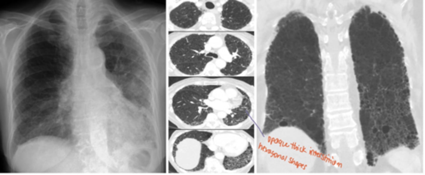 <p>What is this pattern of interstitial lung disease?</p>