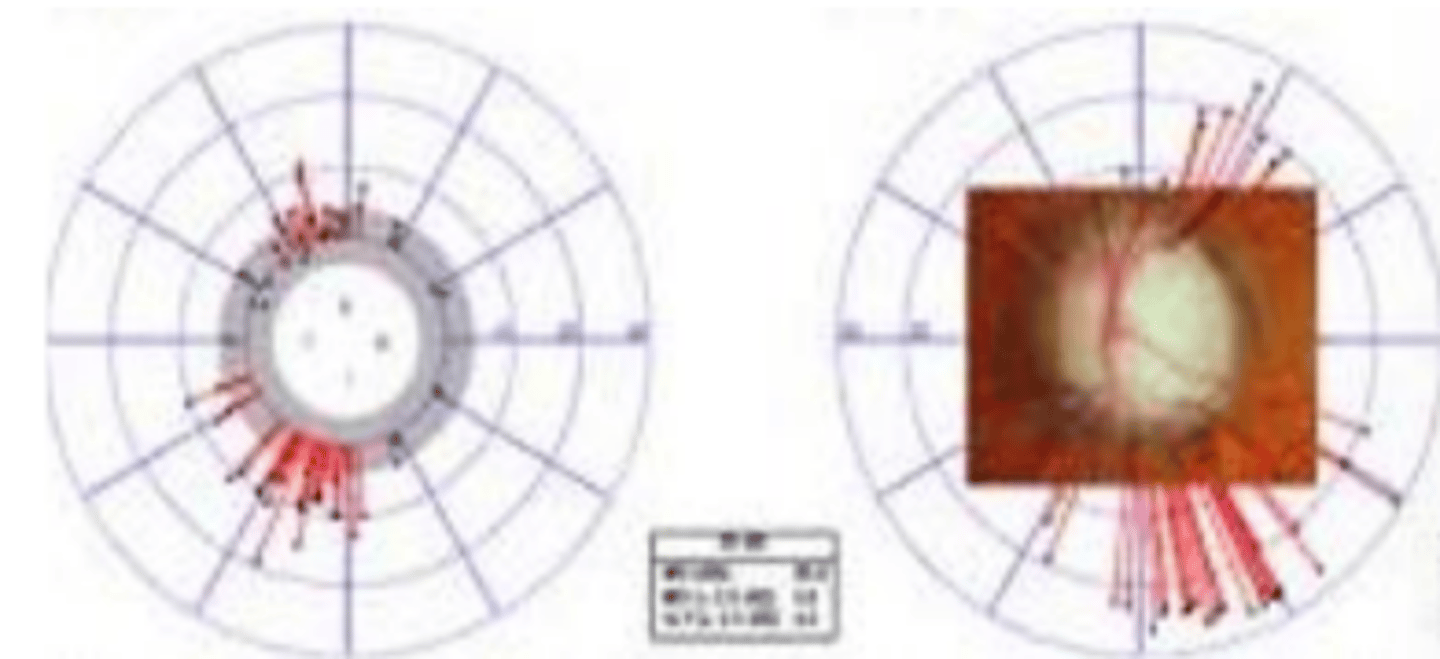 <p>octopus analysis tool that projects local visual field defects along the nerve fibers to the optic disc and displays them oriented as structural results.</p>