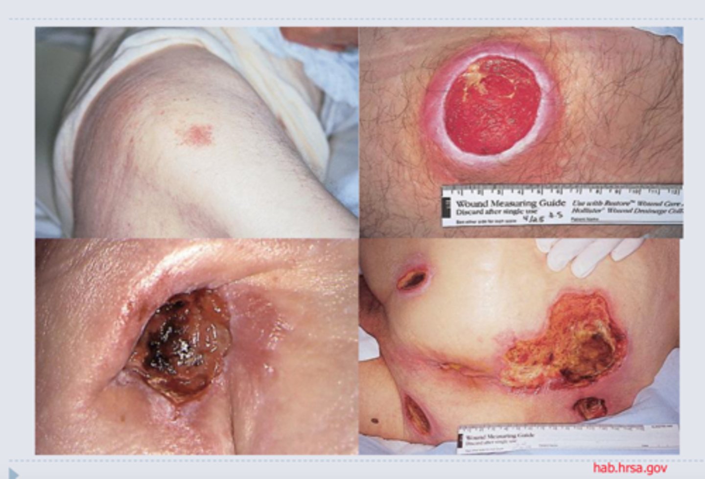 <p>Bedsores caused by problems with dermal circulation.</p><p>Caused by compression of superficial blood vessels</p><p>Sores most common on skin covering joints or bony prominences</p><p>Affects epidermis and dermis</p><p>Kills epithelial cells (easier for bacteria to invade)</p><p>Erodes dermal tissues</p>