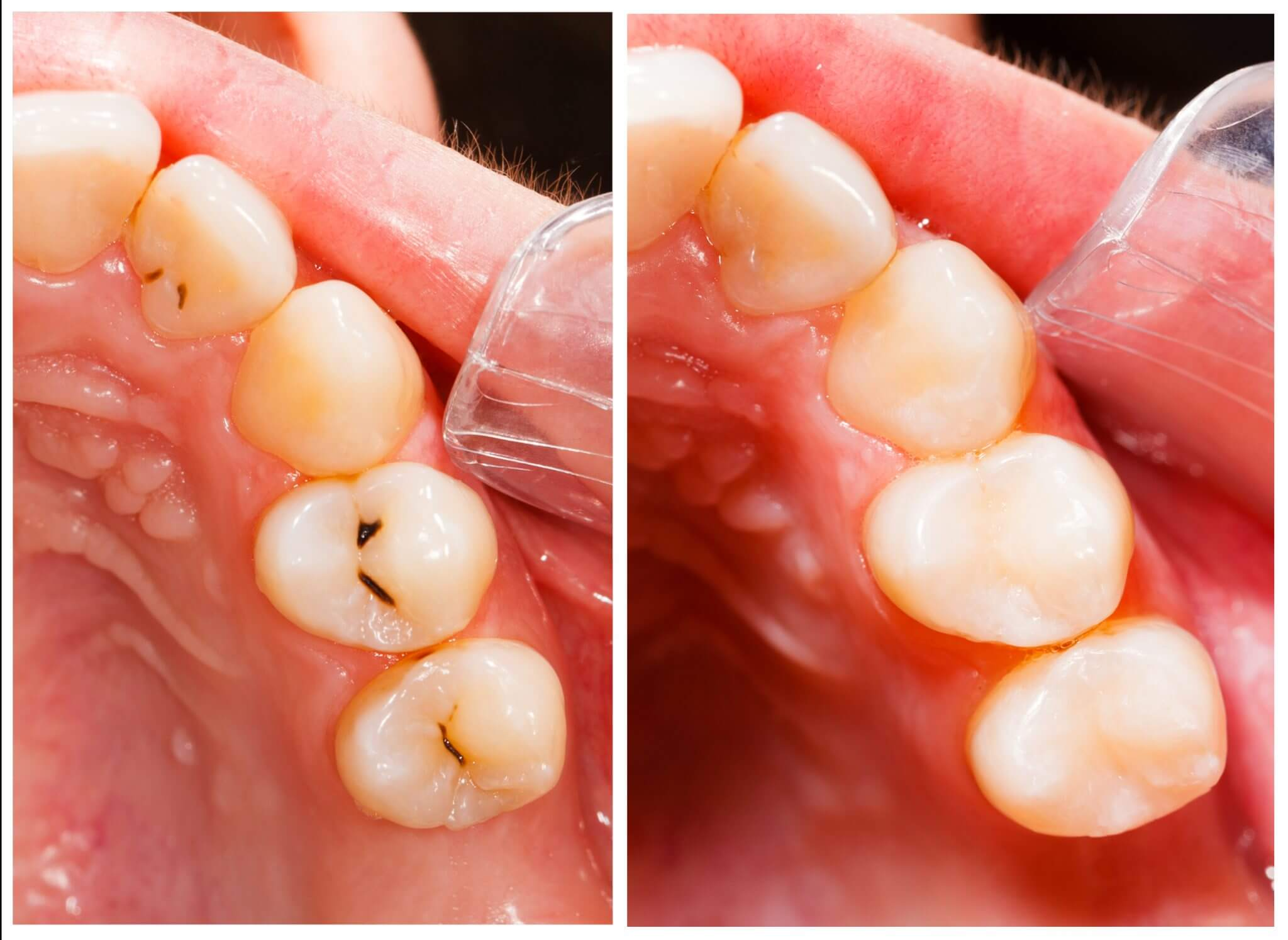 <p>What are Fillings?</p>