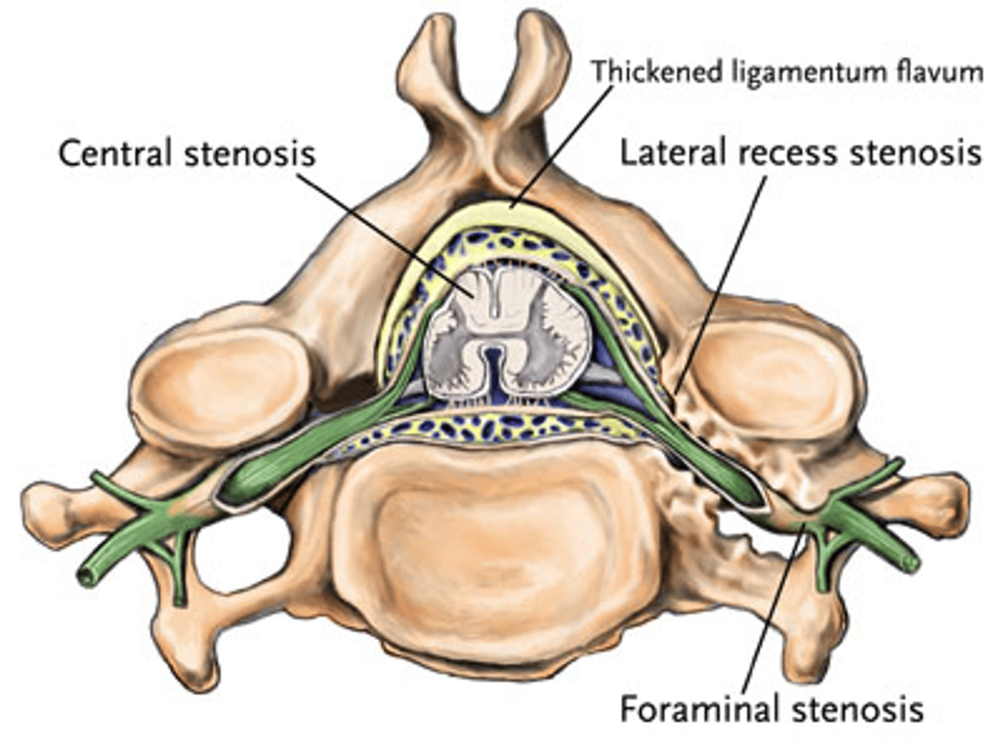 <p>narrowing of the intervertebral foramen</p><p>- from bone spurs, dehydrated disc</p>