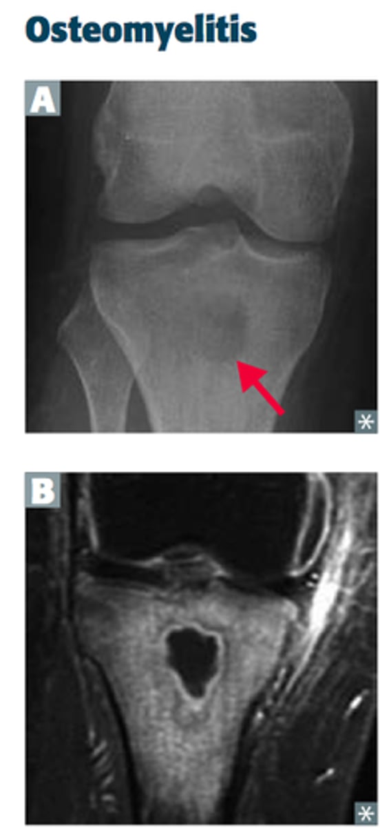 <p>Nothing, it will show classic X-ray triad of demineralization, periosteal reaction, and bone destruction in chronic osteomyelitis</p>