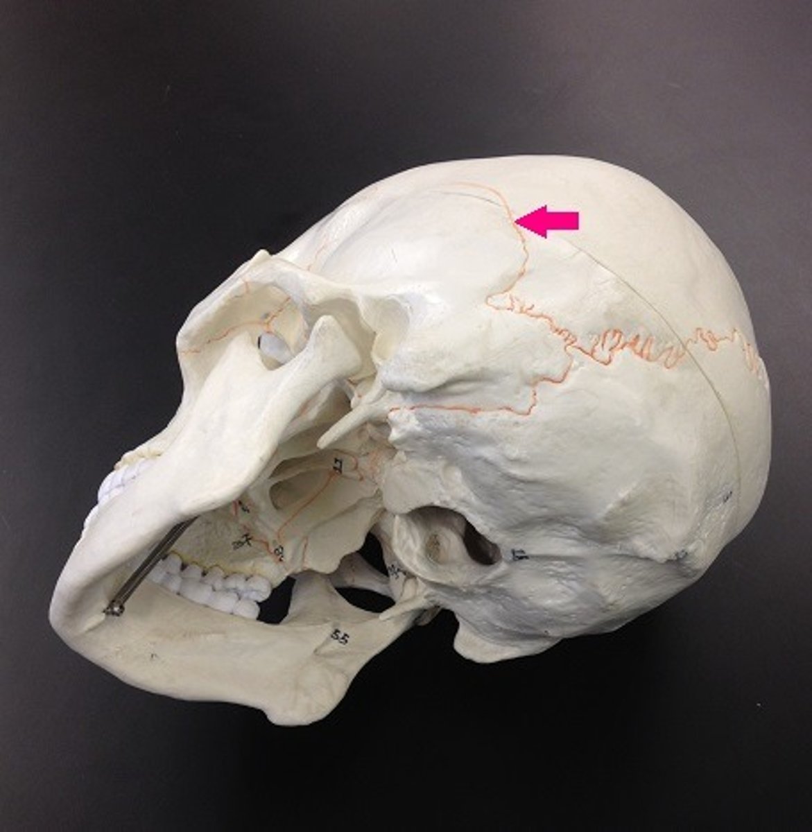 <p>Identify the suture.</p>