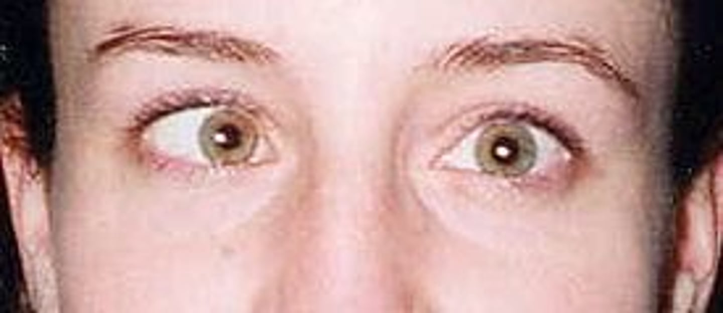 <p>Esotropia</p>