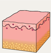inflammatory infiltrate in ACLE - epidermis and superficial dermis