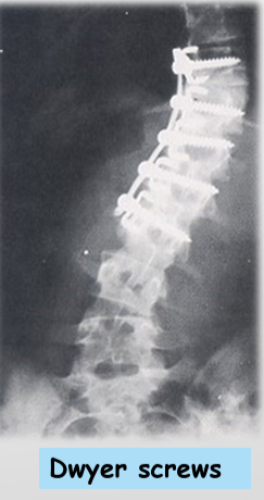 <ul><li><p>Observation: x-rays every 3 months</p></li><li><p>Bracing: curves that are flexible</p></li><li><p>Surgical: curves>40degrees, when underlying abnormality can be treated, attachment of corrective instruments (rods, screws, wires)</p></li></ul><p></p>