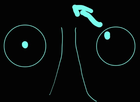 <p>cranial nerve III</p>