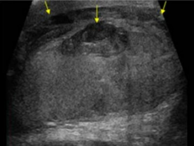 <p>The pathology seen here was seen on a patient whose had trauma to the area. It has become more complex as it sits there. What can be assumed here?</p>