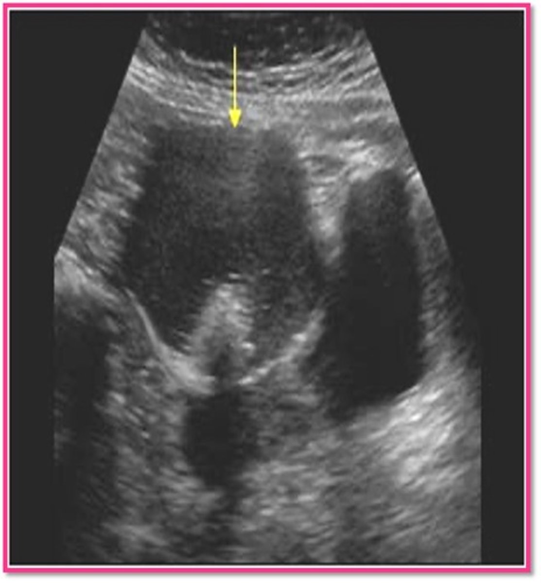 <p>teratoma / dermoid</p>