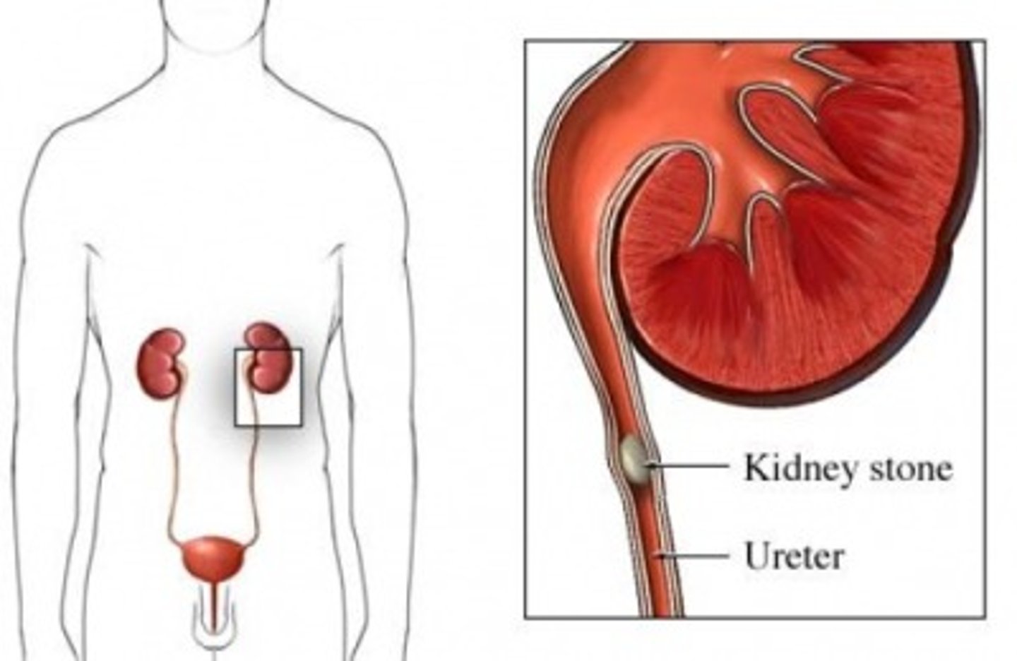 <p>1. Abrupt onset of severe flank pain +/- radiation to groin</p><p>2. Dysuria, frequency</p><p>3. N/V</p><p>4. writhing in pain...not sitting still</p>