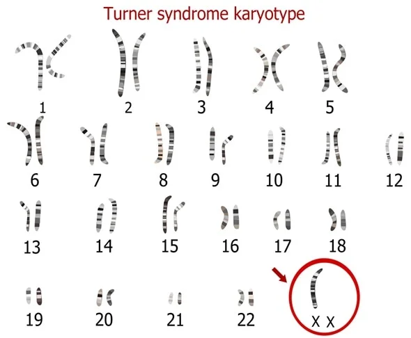 <p>Turner&apos;s Syndrome mutation:</p>